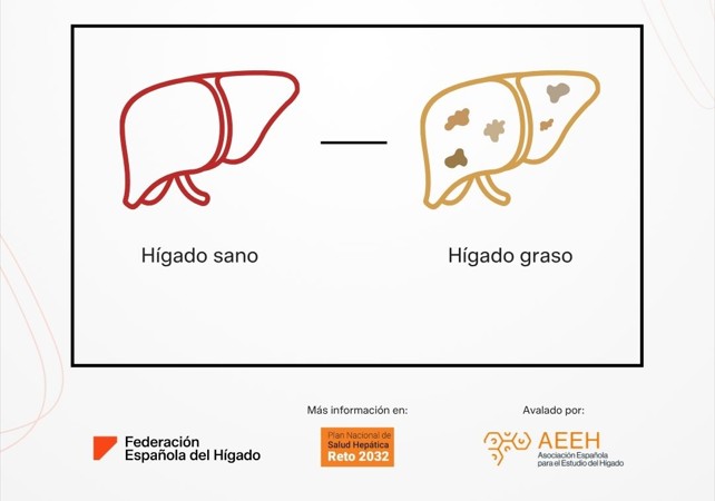 La  AEEH y la FEH lanzan una nueva campaña por el Día Mundial de la Esteatosis Hepática Metabolica: “La prevención empieza con la información”